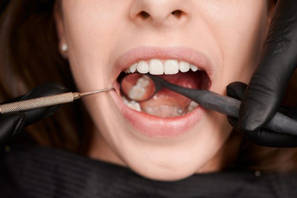 broken tooth treatments campbelltown