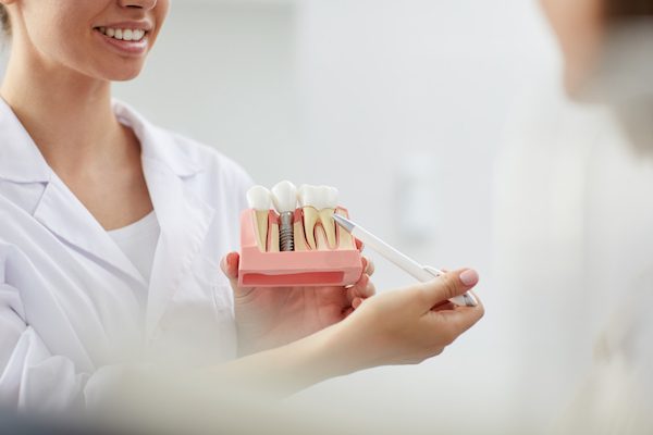components of dental implants campbelltown
