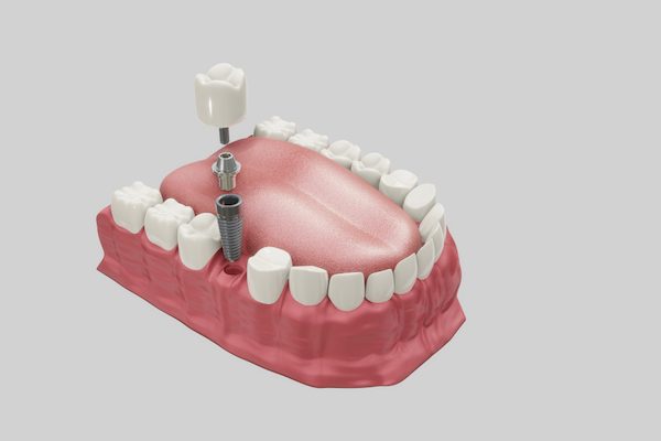 dental implantation procedure campbelltown