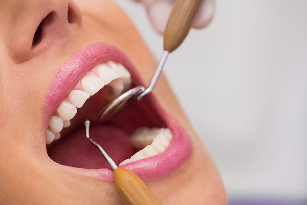 professional dental cleaning campbelltown