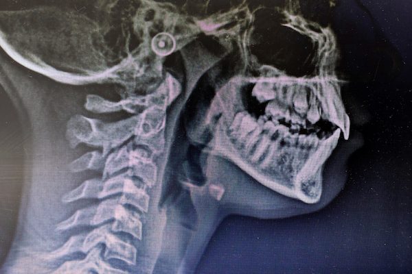 causes of tmj disorder campbelltown
