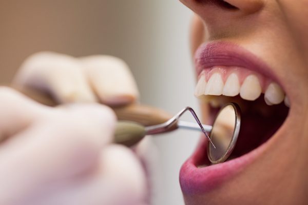 the dental bonding procedure campbelltown