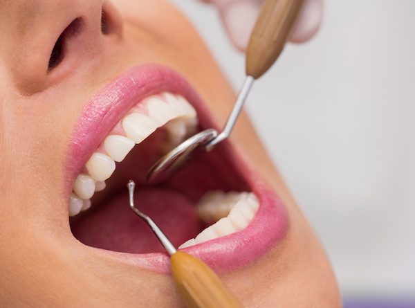 when should dental bonding be used campbelltown