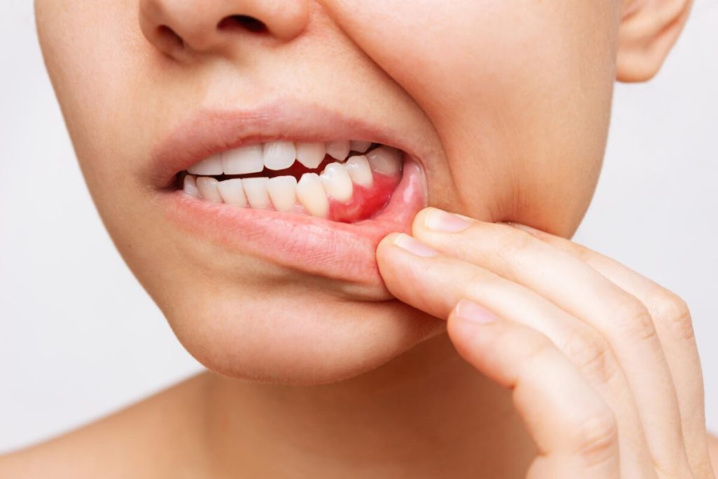gingivitis causes symptoms and treatment options marketfair dental care