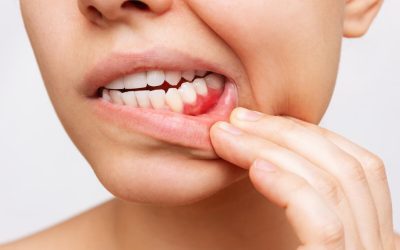 Understanding Gingivitis: Causes, Symptoms, and Treatment Options