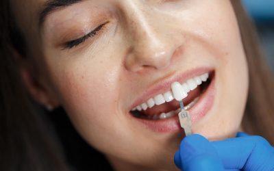 Dental Veneers: Are They Right for You?